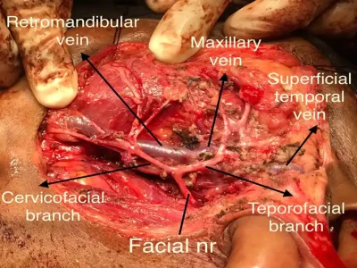 TOTAL-CONSERVATIVE-PARIOTIDECTOMY