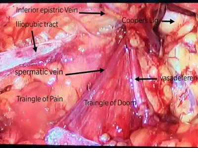LAP-TAPP-INGUINAL-HERNIA