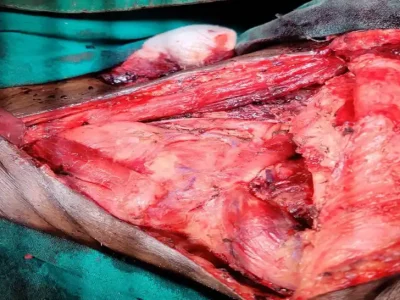 NECK-DISSECTION