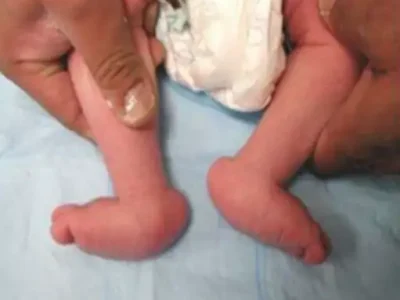 ARTIFICIAL LIMB