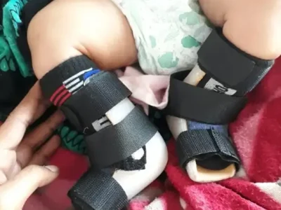 ARTIFICIAL LIMB