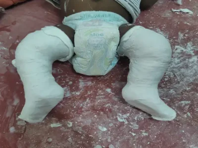 ARTIFICIAL LIMB
